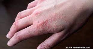 Berbagai Jenis Alergi Pada Tubuh Manusia Serta Penyebabnya